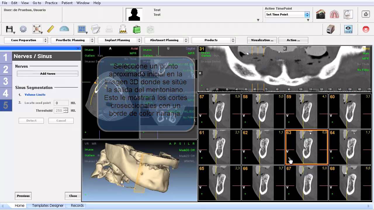 NemoScan Implantology Premium v11 Castellano