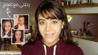 My Vitiligo Story - رحلتي مع العلاج