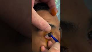 Como Tirar Lente De Contato Com Ventosa