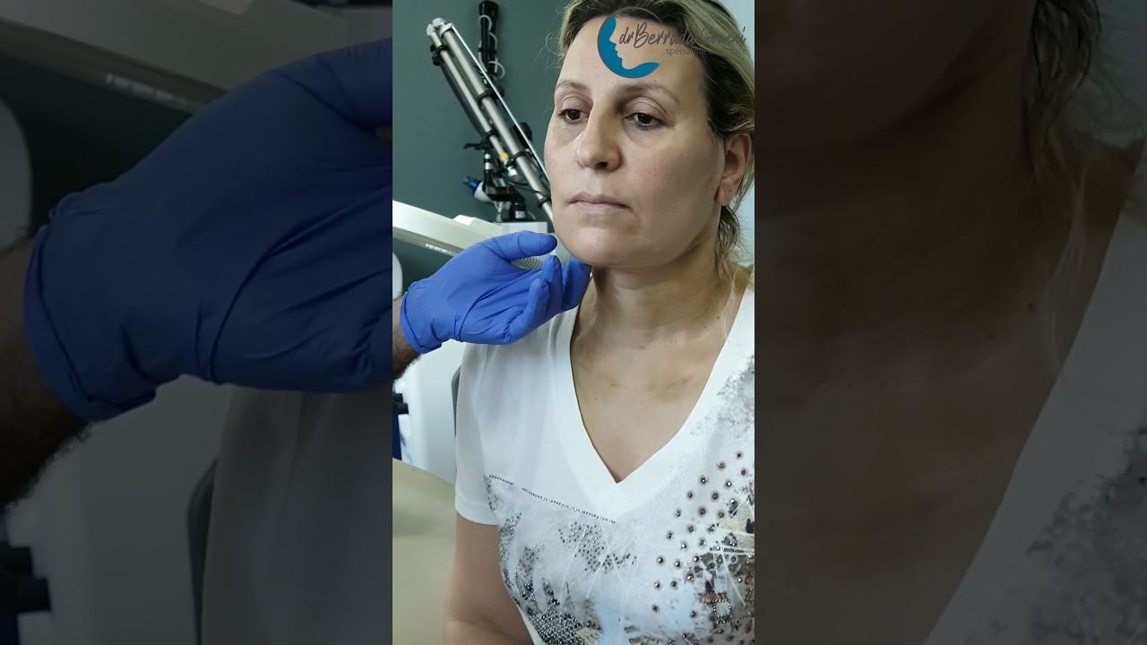 Témoignage de lifting cervicofacial nouvelle technique deepplanefacelift