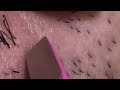 【Plucking facial hair】ずっと見ていられる熟練のヒゲ抜き 2018 9 18（アゴヒゲ編②）