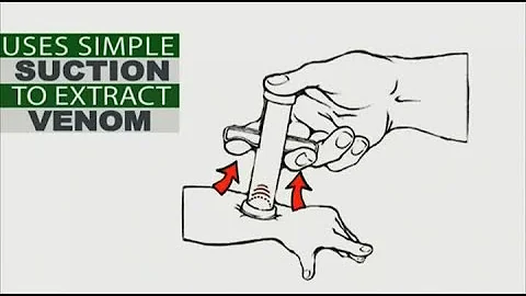 Florida mom invents device to make mosquito bites stop itching