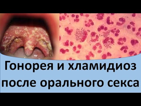 Гонорея и хламидиоз после орального секса
