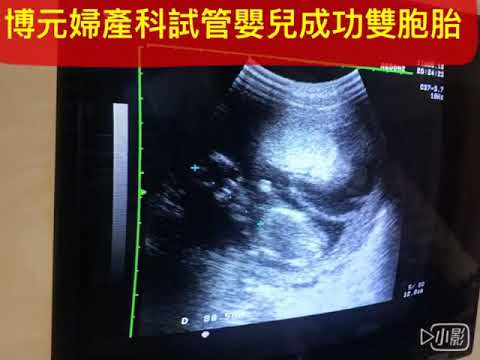 博元婦產科試管嬰兒成功