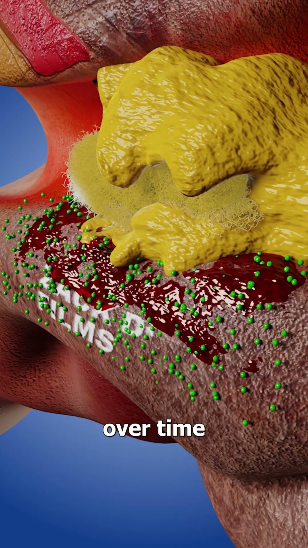 Cotton Swab Gets Stuck In Your Ear ?