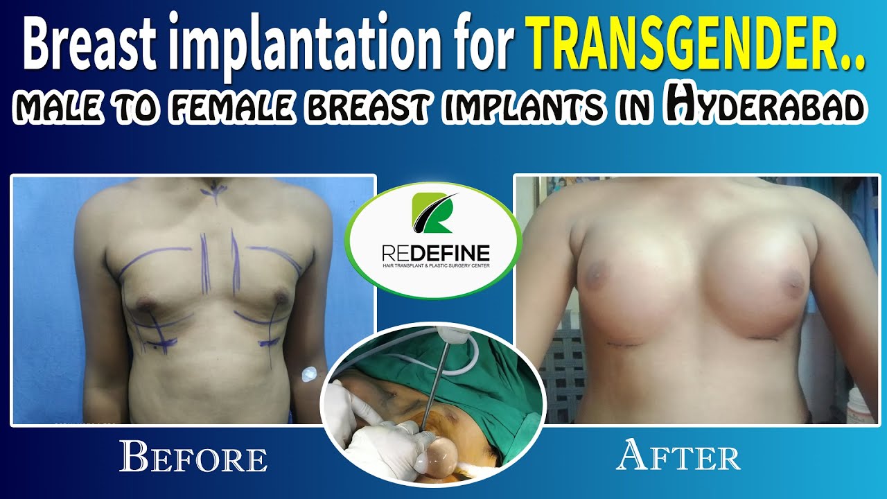Breast Augmentation - Gender Confirmation
