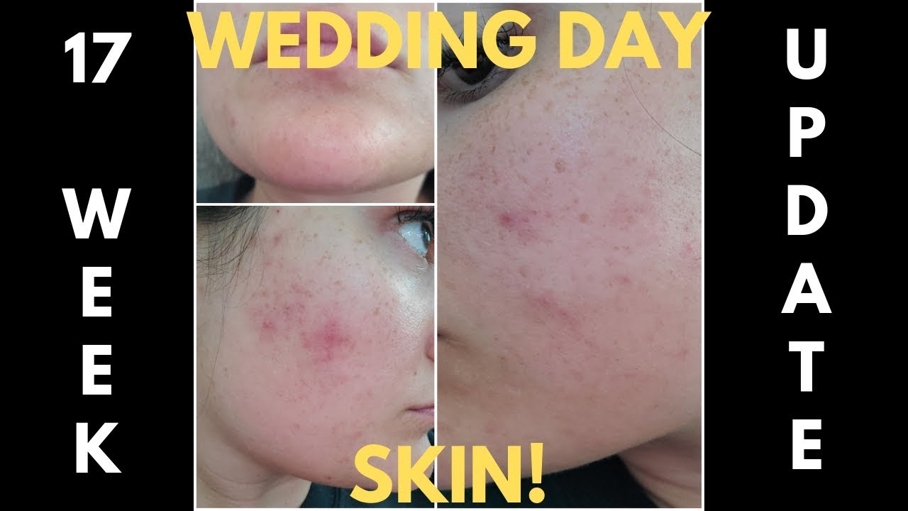 Spironolactone for Acne! 17 WEEK UPDATE! (My Wedding Day Skin!!) - Episode #15