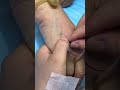 Injection Technique Made Simple | Types of Needle Injections You Need To Know 10