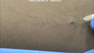 Vene escleroterapia