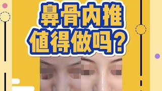 隆鼻时 医生一般会建议鼻骨内推一起做 这个值得做吗 Youtube 隆鼻时 医生一般会建议鼻骨内推一起做 这个值得做吗 Youtube