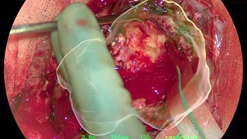 Benefits of integrating digital technologies into neurosurgical procedures