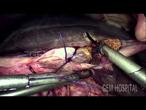 Laparoscopic Radical Cholecystectomy for Early Carcinoma Gall Bladder