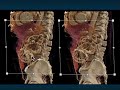 MDCT/CTA Evaluation of the Suspected Renal Mass: Key Differential Clues – Part 2