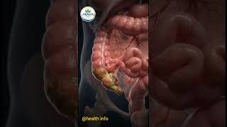 ⚠️ Appendicitis Can Turn Deadly in Hours! Don't Ignore These Warning Signs 😱🚑