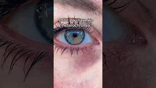 IRIS Heterochromia (coloured EYE 👁️) 🧡 #eyes #rare #aesthetic