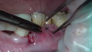 Augment Keratinized Gingiva via Bilaminar Technique(CAF+CTG) part 9