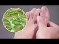 Schollmed Once Weekly* Fungal Nail Treatment