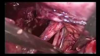 Laparoscopic excision excision endometriosis with pelvic lymphadenectomy: Clean&Clear