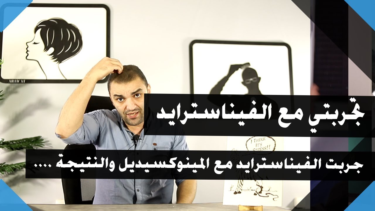 تجربتي في استخدام الفيناسترايد لعلاج الصلع الفيناسترايد مع المينوكسيديل