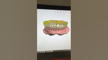 digital denture!! 🐸 use ivotion base print