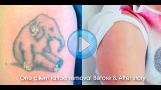 Laser Tattoo Removal Before & After Final Results 8 Stage Treatment Tutorial