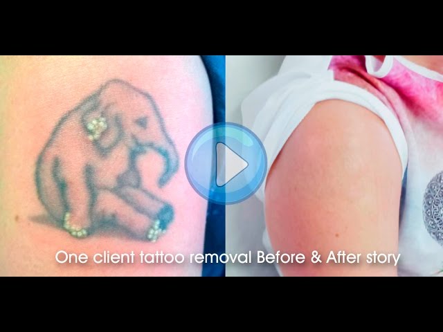 Program offers free tattoo removal in Detroit