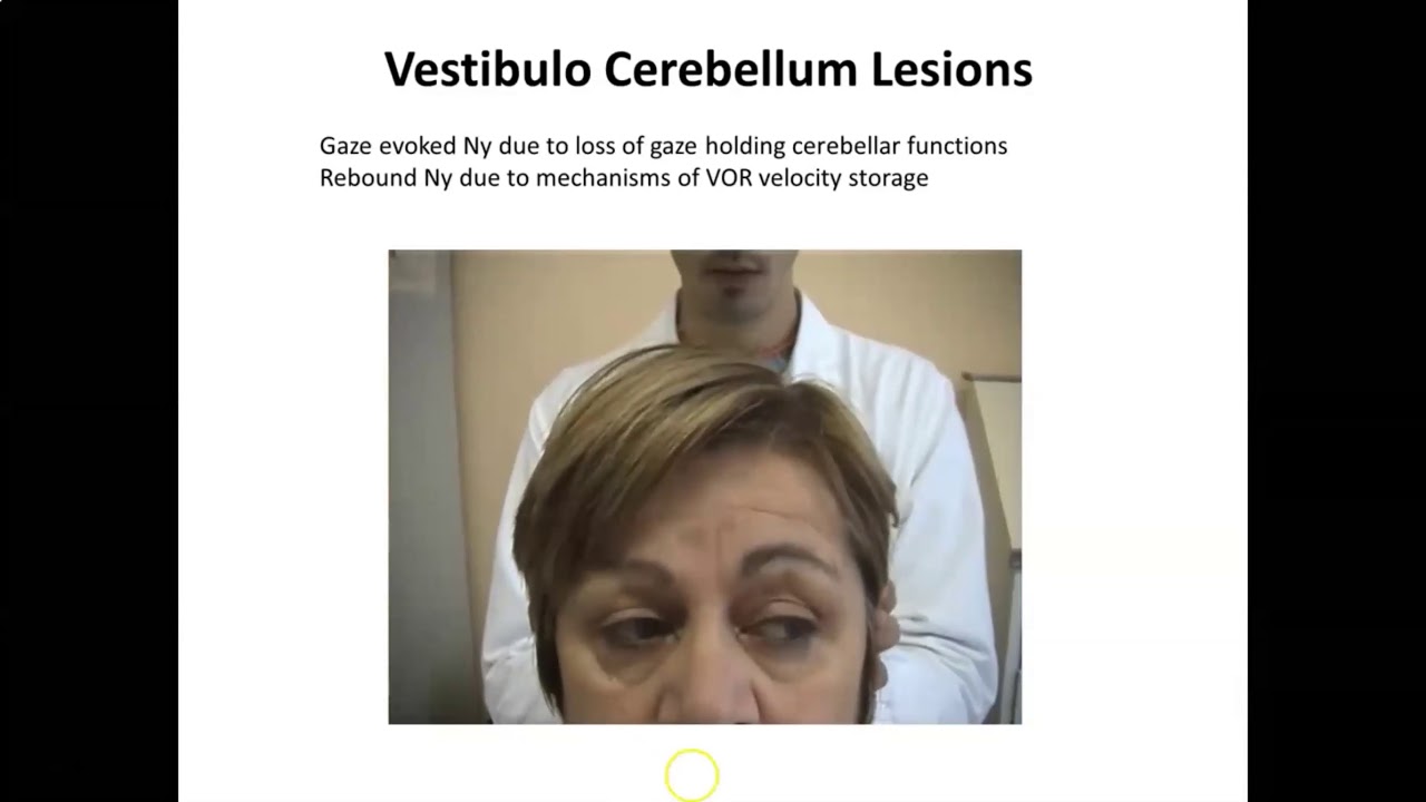 Eye Movements In Inherited Ataxia | Alessandra Rufa - YouTube