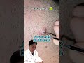 【埋没毛】バリカンやカミソリで皮膚が傷つくことによって埋まる毛！引っ張り出してみたらとてつもないほどの量の毛が！