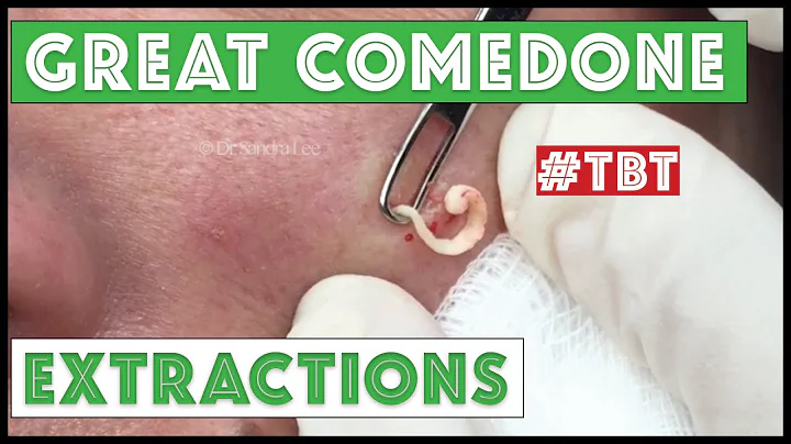 Greatest Blackheads and Whiteheads TBT