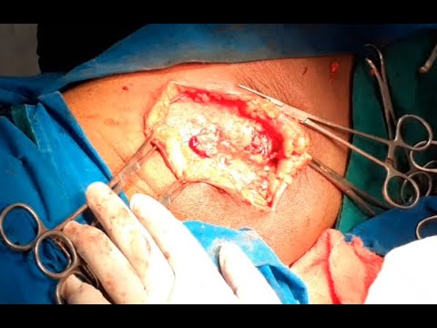 Deep thigh abscess | Drainage with debridement| Fat necrosis| Excision| Diabetes| Dr. Pandiaraja
