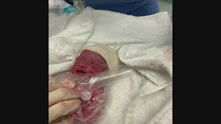 Davenport Couples First Child Born 10 Weeks Early, Weighing Only 2 Pounds, 12 Ounces