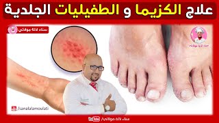 وصفات لعلاج الكزيما والطفيليات الجلدية من عند الدكتور عماد ميزاب Dr imad Mizab