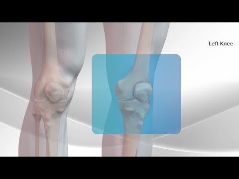 All-Inside ACL Reconstruction