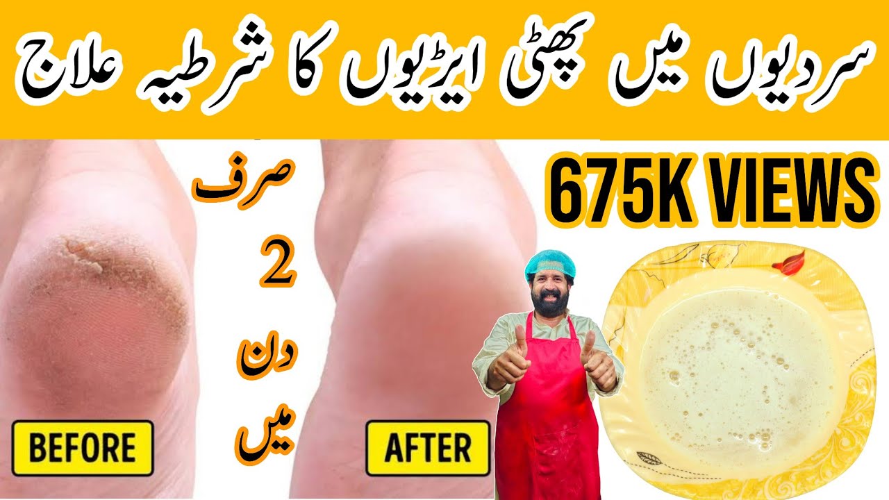 फटी ऐड़ियों से पाये छुटकारा इन आसान घरेलू नुस्खों से Get rid with home  remedies for cracked heels