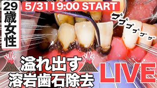 【29歳女性】溢れ出る⁉️溶岩歯石除去LIVE