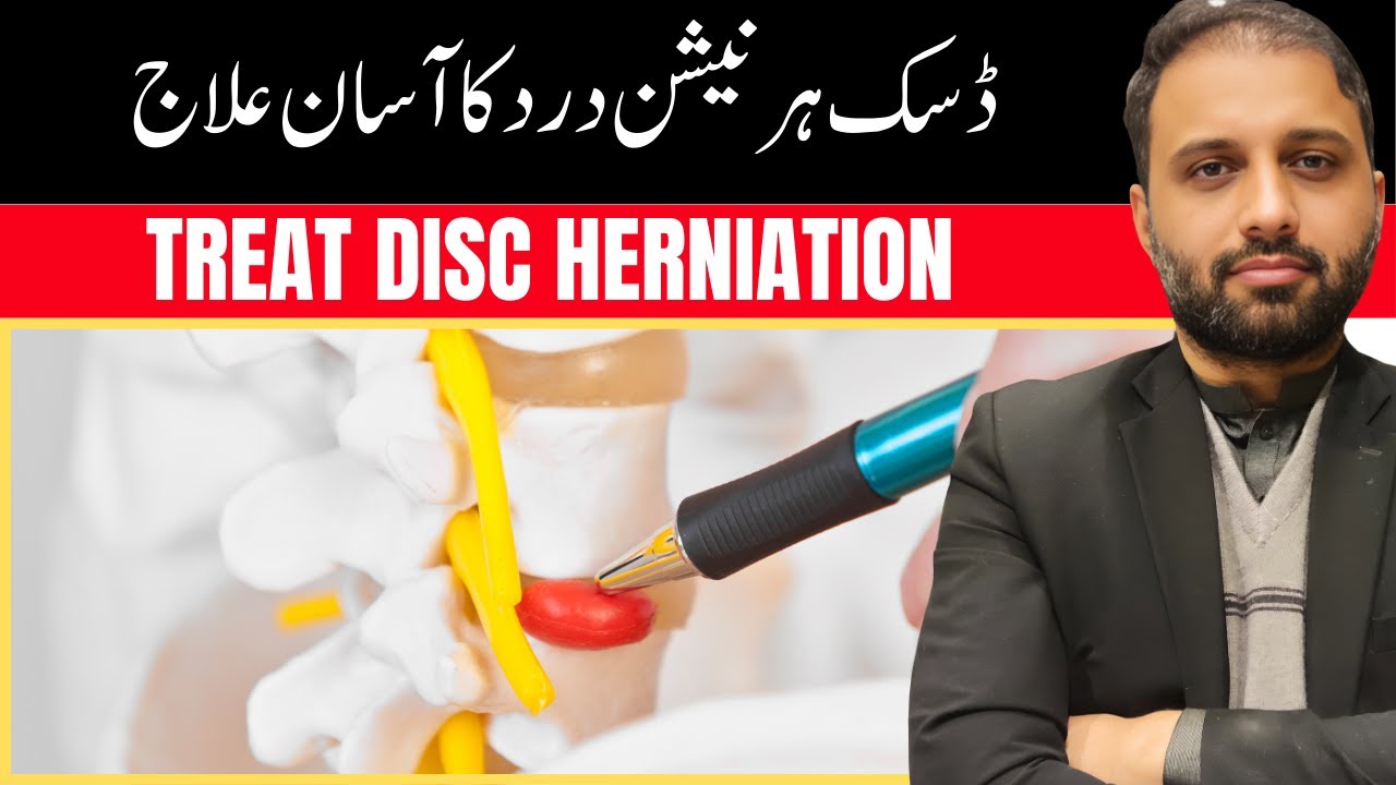 How to Treat Herniated Disc | Herniated Disc Treatment | Disc Herniation Exercises