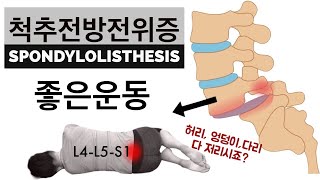 척추전방전위증이라면 반드시 해야 운동 5가지