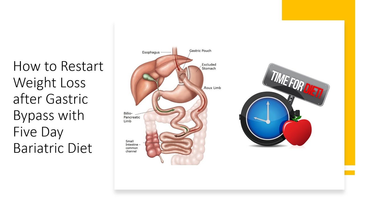 Weight Loss After Gastric Bypass