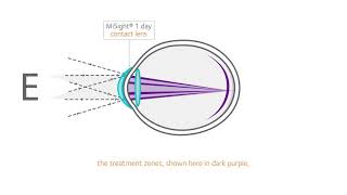 How does MiSight work? screenshot 2