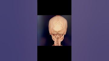 Headache and dizziness relief - upper cervical chiropractic