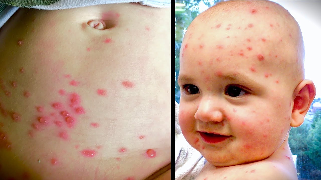 BAD CASE Of CHICKEN POX Varicella Dr Paul YouTube BAD CASE Of CHICKEN POX Varicella Dr Paul YouTube