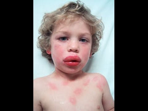 Image result for anaphylaxis shock kid
