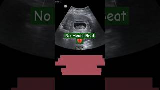 Vaginal bleeding at 6 weeks | Ultrasound reveals...