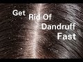 How To Get Rid Of Dandruff Fast / 5 Ways