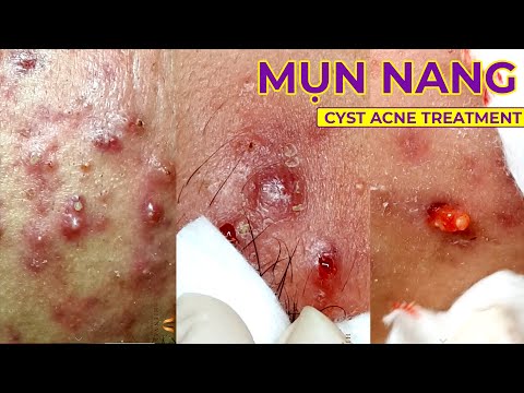 Video Điều trị mụn nang hiệu quả tại TPHCM | Hiền Vân Spa |... - youtube