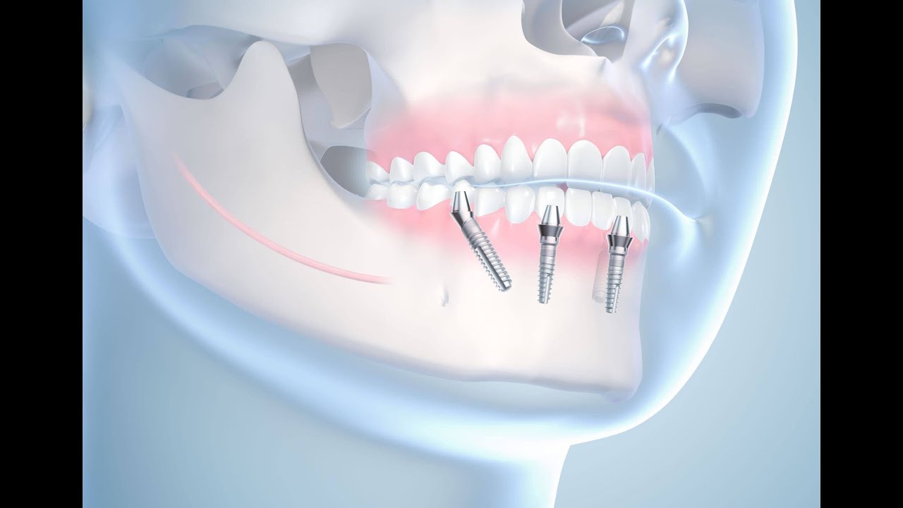 Имплантация зубов all-on-4 или Все на 4