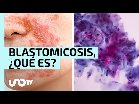 Vídeo: A qui afecta la blastomicosi?
