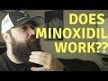 Is Minoxidil SAFE for a patchy beard? | Things you NEED to know