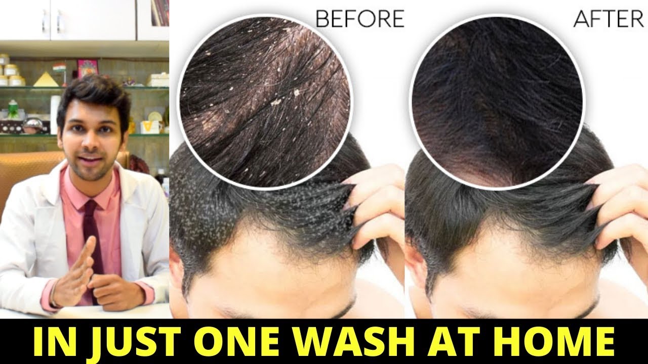 How to Clear Dandruff Permanently | Dandruff & Hair Loss Natural Solution at Home | JYOVIS ...