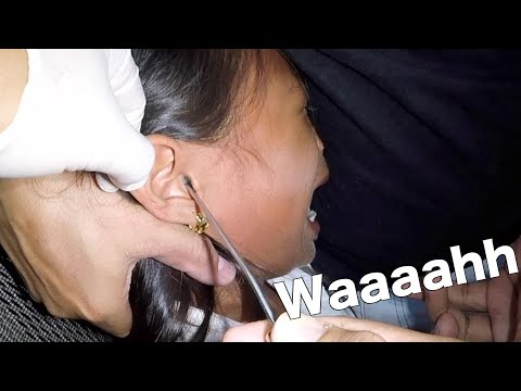 How to Remove a Styrofoam Ball Stuck in Girl's Ear | Can She Handle It?